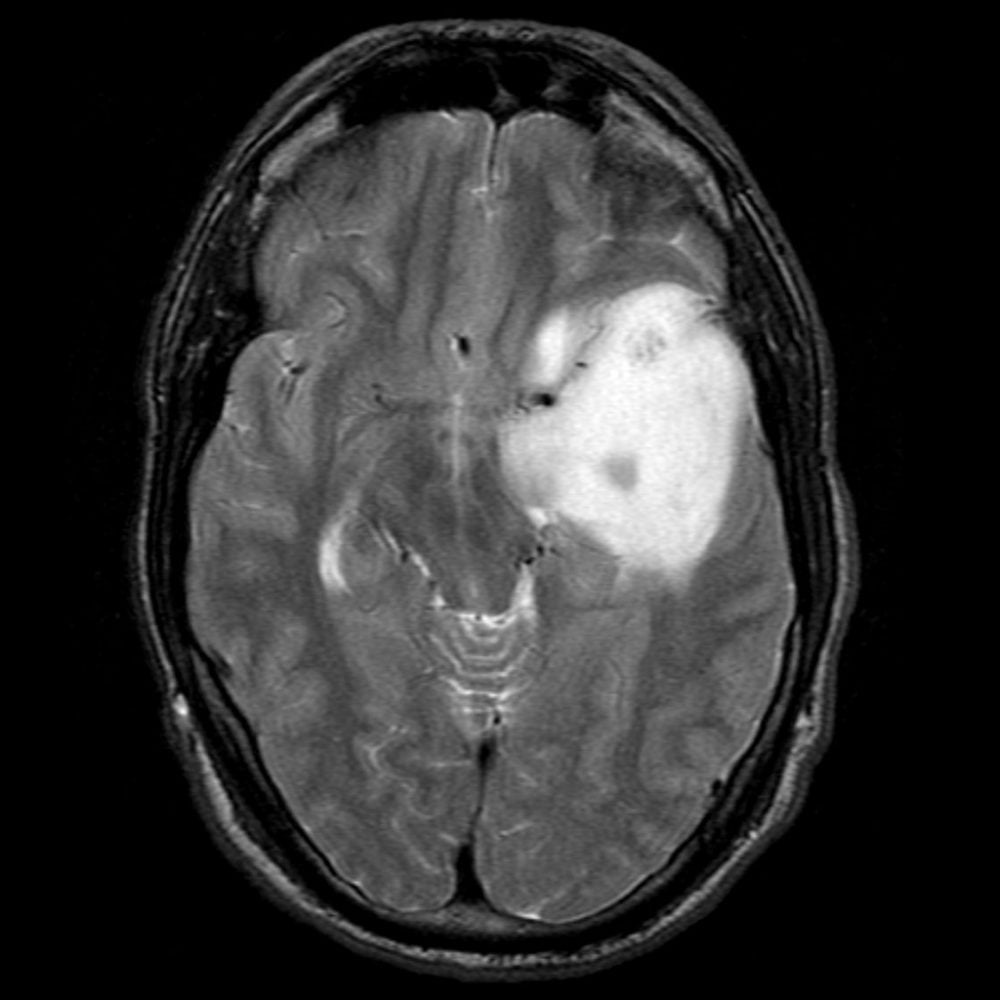 Снимки МРТ и КТ. Нейронально-глиальные опухоли