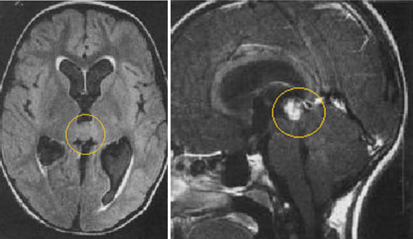 Снимки МРТ и КТ. Опухоли шишковидной железы