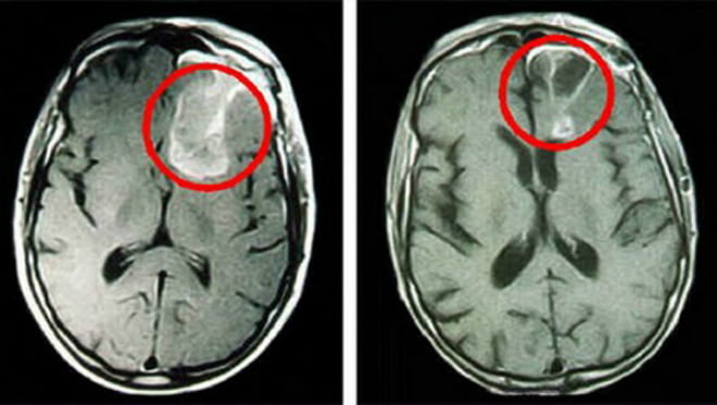 Снимки МРТ и КТ. Глиомы высокой степени анаплазии