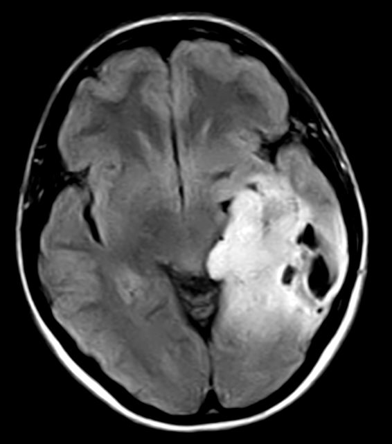 Снимки МРТ и КТ. Глиоматоз головного мозга