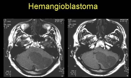 Снимки МРТ и КТ. Гемангиобластома головного мозга