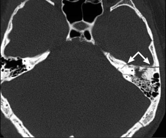 Снимки МРТ и КТ. Переломы пирамиды височной кости