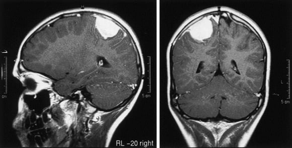 Снимки МРТ и КТ. Менингиома головного мозга