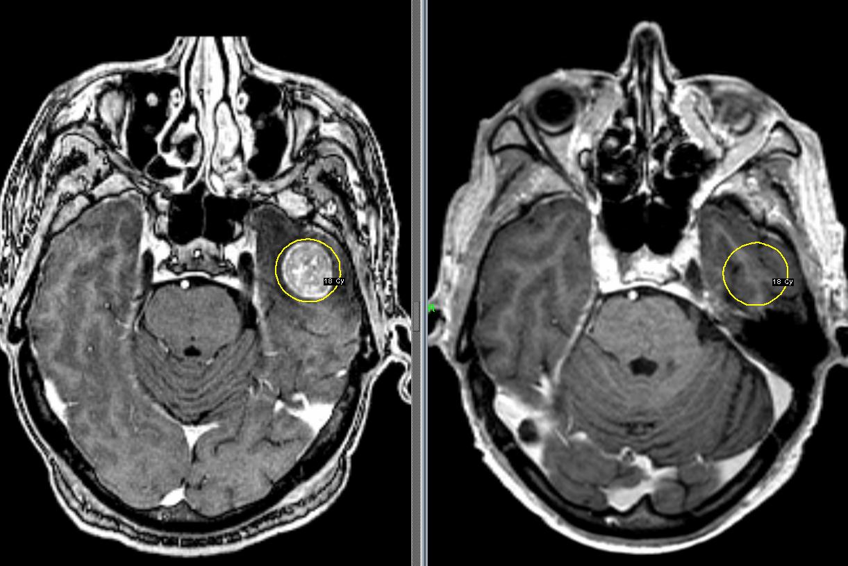Снимки МРТ и КТ. Метастазы в головной мозг
