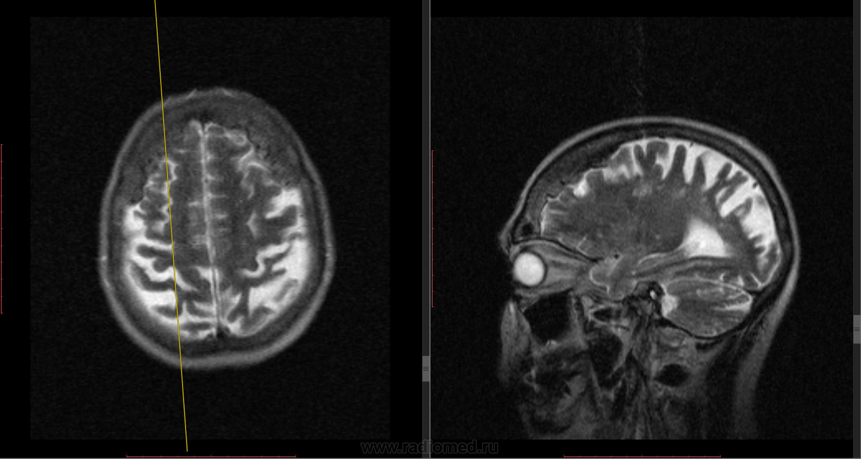 Снимки МРТ и КТ. Лобный гиперостоз основания черепа